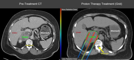 Pre Treatment CT scan versus Proton Therapy treatment scan for Sarcoma.