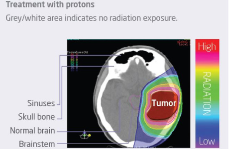 A brain scan showing treatment of a tumor with protons.