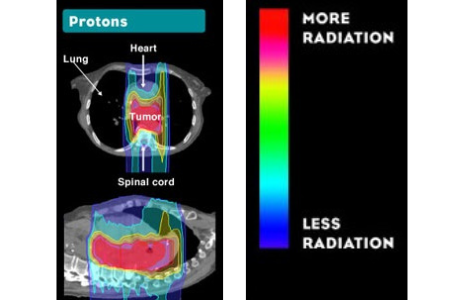 Esophagus proton scan