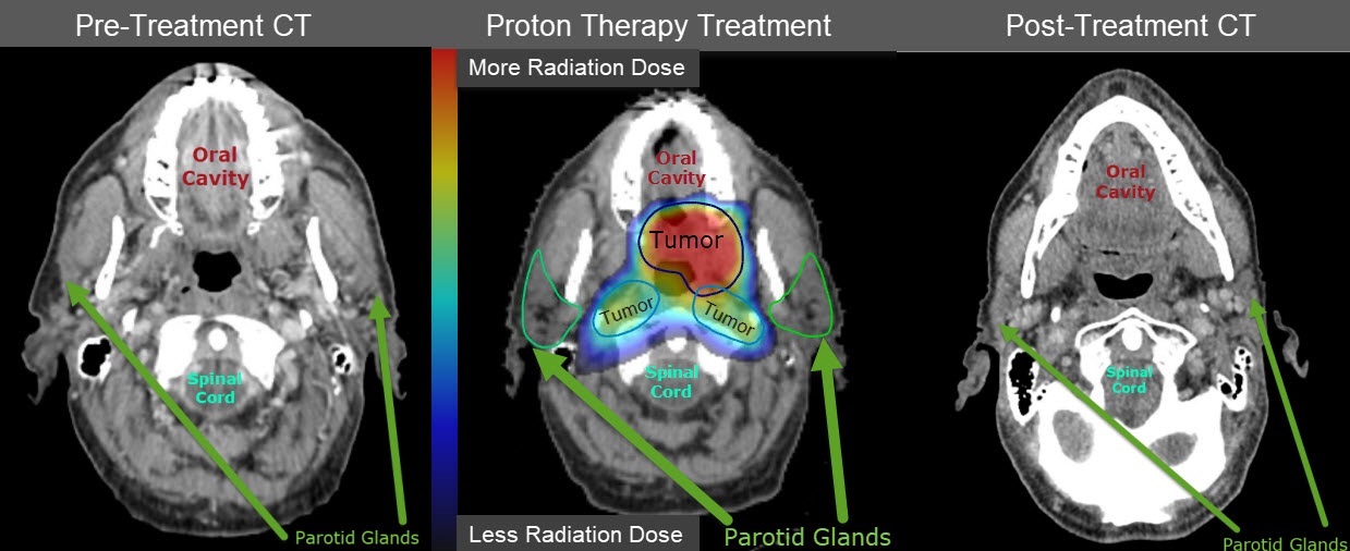 Head and neck scan pre and post treatment