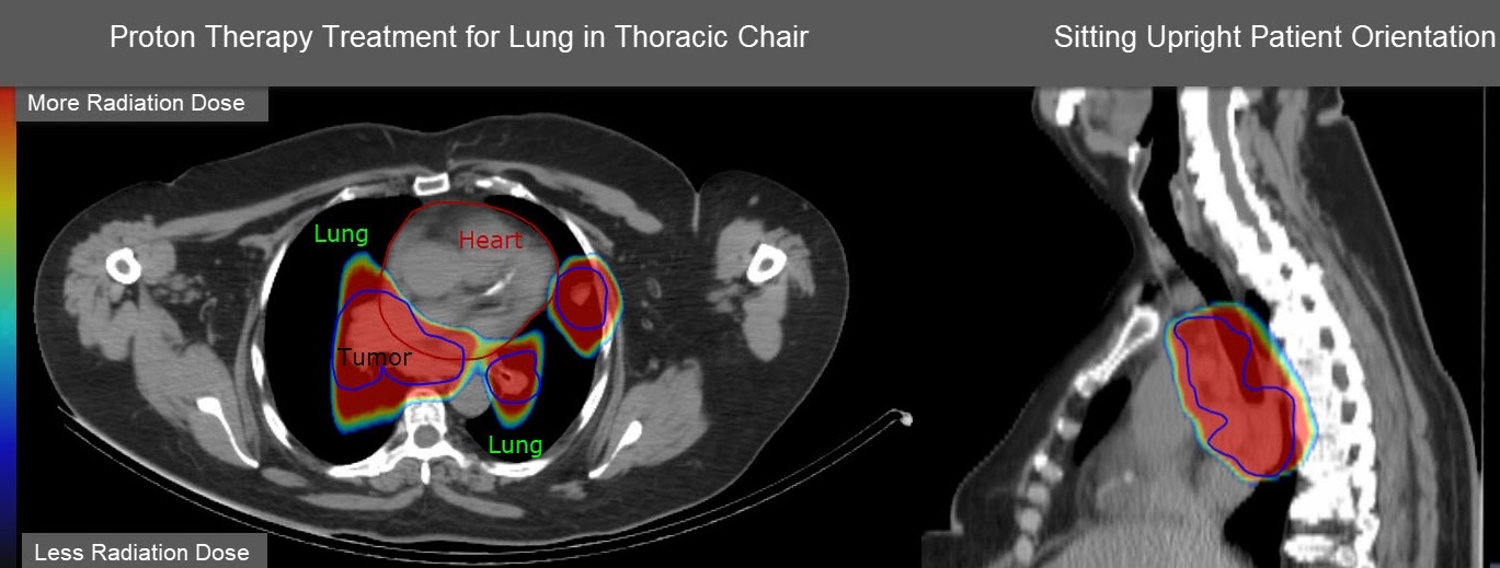 A lung scan of a proton therapy patient.