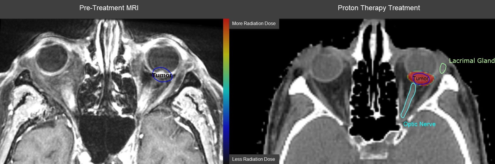 Melanoma Ocular Scan pre and post treatment