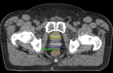 A scan of a male showing prostate location