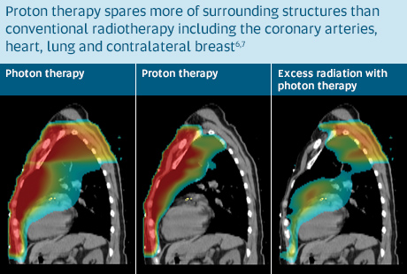 Breast Tumor Proton Therapy | Northwestern Medicine Proton Center